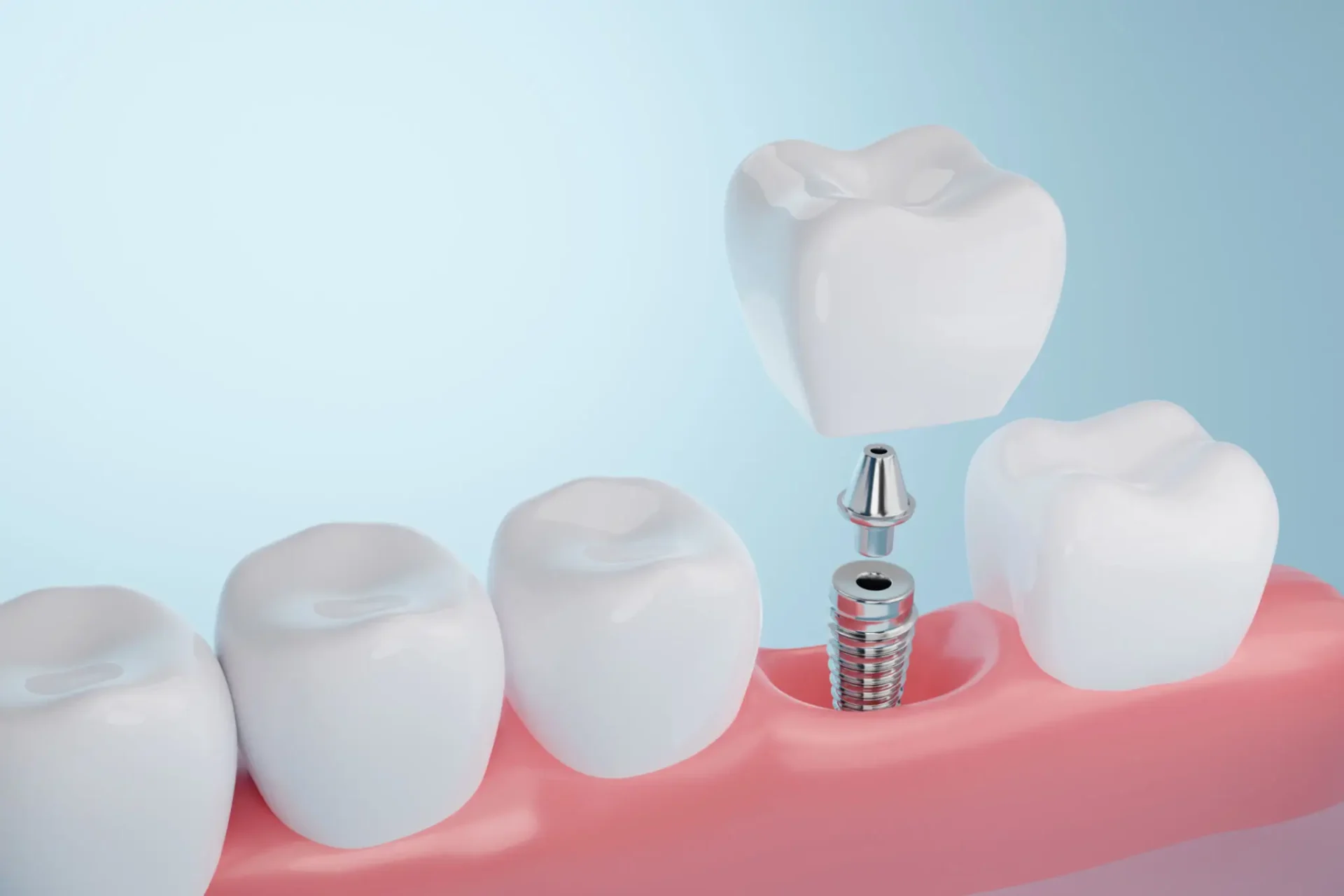 Dental implant model showing crown and gum.